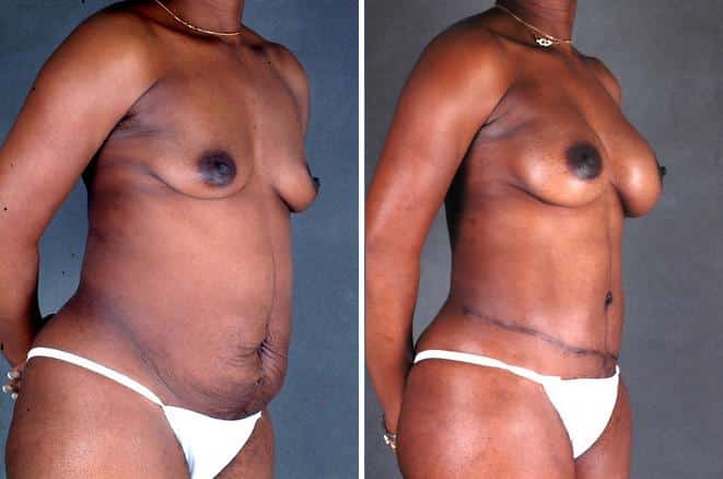 Tummy Tuck Before and After Photos in Omaha, NE, Case 4927