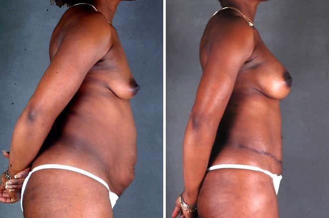 Tummy Tuck Before and After Photos in Omaha, NE, Case 4927