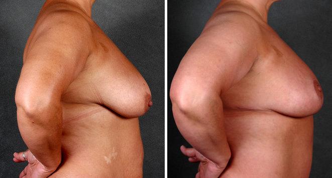 Case 4933, Tummy Tuck Before and After Photos Tummy Tuck Before and After Photos in Omaha, NE, Case 4933