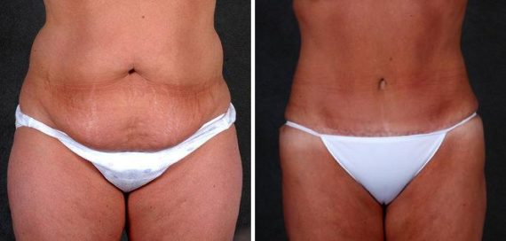 Tummy Tuck Before and After Photos in Omaha, NE, Case 4880