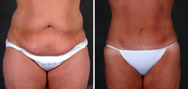 Tummy Tuck Before and After Photos in Omaha, NE, Case 4880