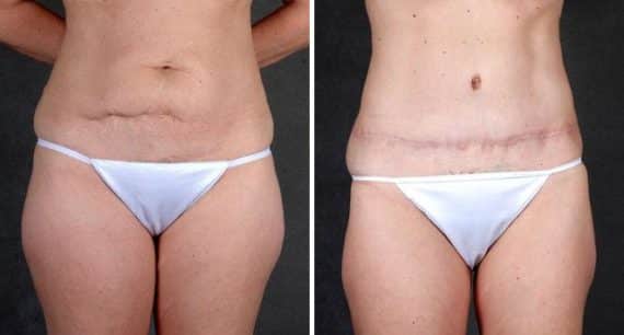 Tummy Tuck Before and After Photos in Omaha, NE, Case 4941