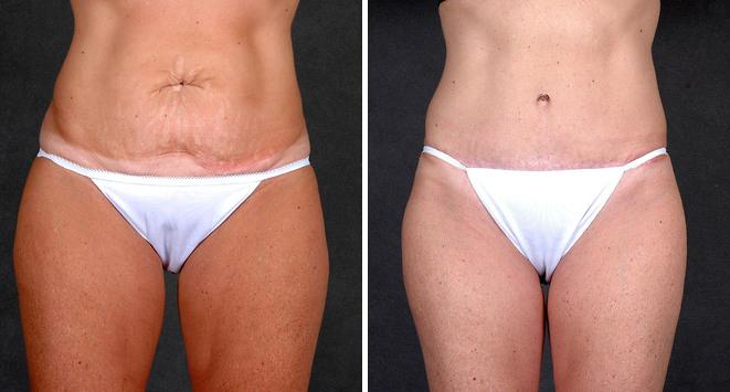 Tummy Tuck Before and After Photos in Omaha, NE, Case 4950