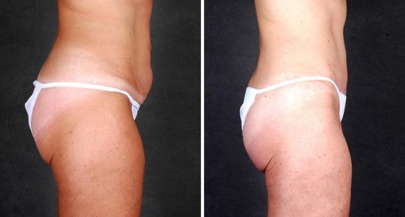 Tummy Tuck Before and After Photos in Omaha, NE, Case 4950