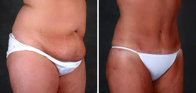 Tummy Tuck Before and After Photos in Omaha, NE, Case 4880