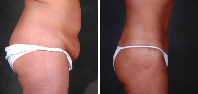 Tummy Tuck Before and After Photos in Omaha, NE, Case 4880