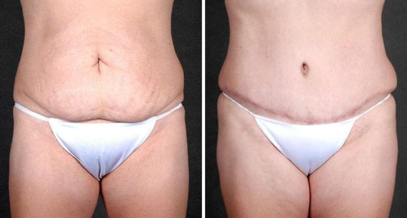 Tummy Tuck Before and After Photos in Omaha, NE, Case 4865