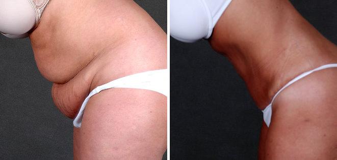 Tummy Tuck Before and After Photos in Omaha, NE, Case 4880