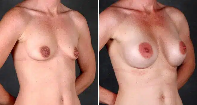 Breast Augmentation Before and After Photos in Omaha, NE, Case 4934