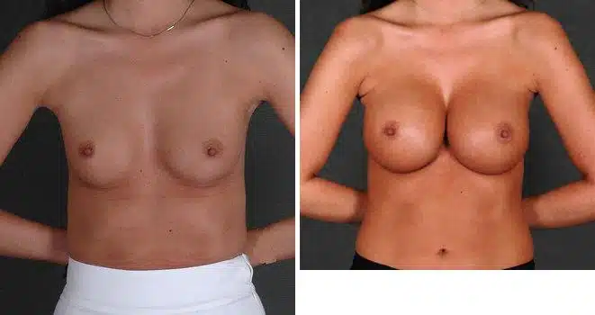 Breast Augmentation Before and After Photos in Omaha, NE, Case 4967