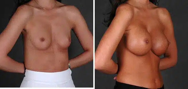 Breast Augmentation Before and After Photos in Omaha, NE, Case 4967