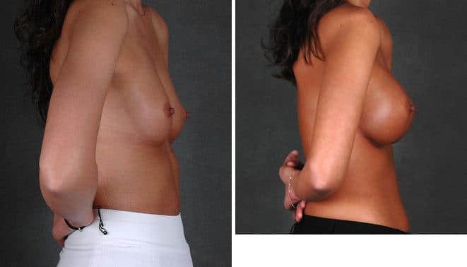 Breast Augmentation Before and After Photos in Omaha, NE, Case 4967