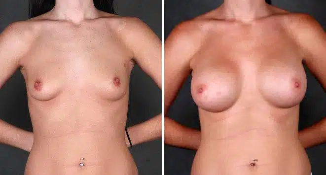 Breast Augmentation Before and After Photos in Omaha, NE, Case 4975