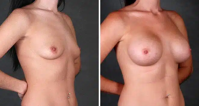 Breast Augmentation Before and After Photos in Omaha, NE, Case 4975