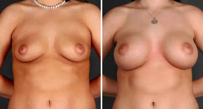 Breast Augmentation Before and After Photos in Omaha, NE, Case 4984