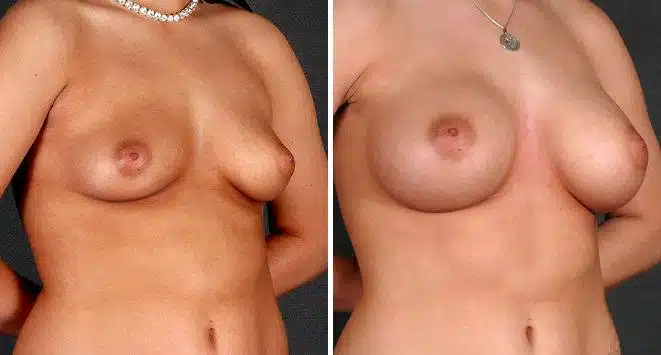 Breast Augmentation Before and After Photos in Omaha, NE, Case 4984