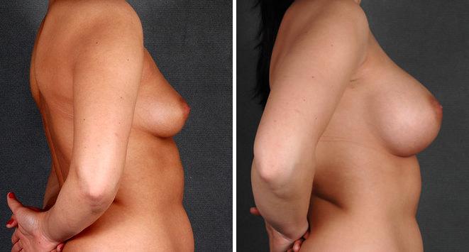 Breast Augmentation Before and After Photos in Omaha, NE, Case 4984