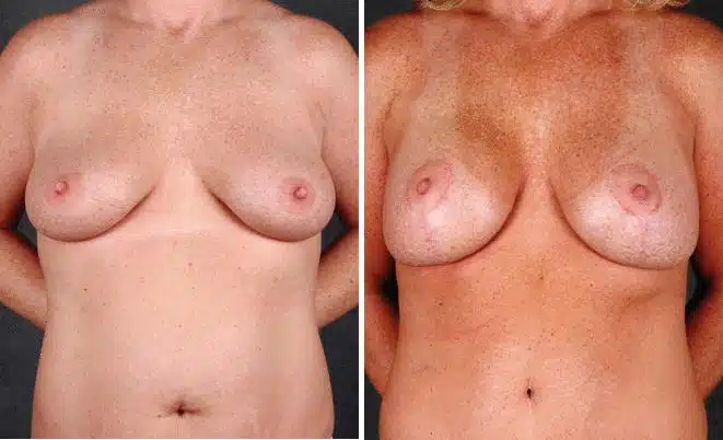 Breast Augmentation Before and After Photos in Omaha, NE, Case 4992