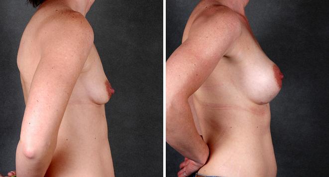 Breast Augmentation Before and After Photos in Omaha, NE, Case 4934