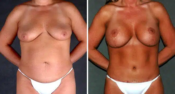 Breast Augmentation Before and After Photos in Omaha, NE, Case 4943