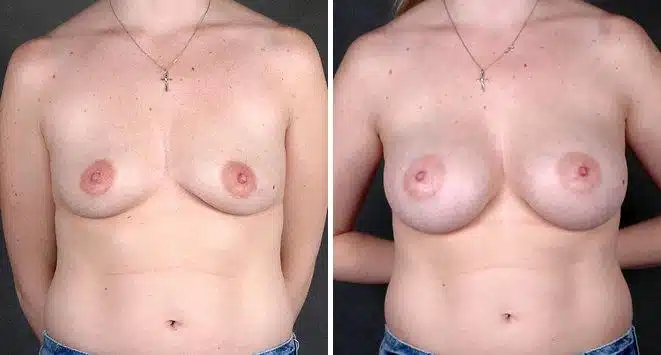 Breast Augmentation Before and After Photos in Omaha, NE, Case 5013