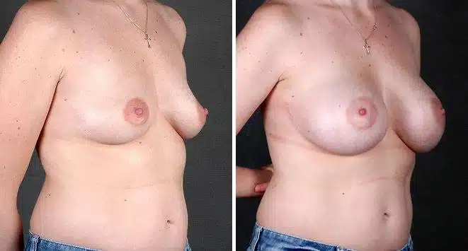 Breast Augmentation Before and After Photos in Omaha, NE, Case 5013