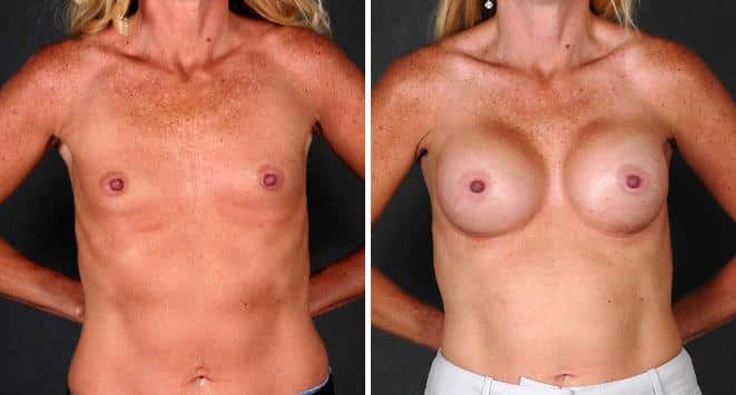 Breast Augmentation Before and After Photos in Omaha, NE, Case 5021