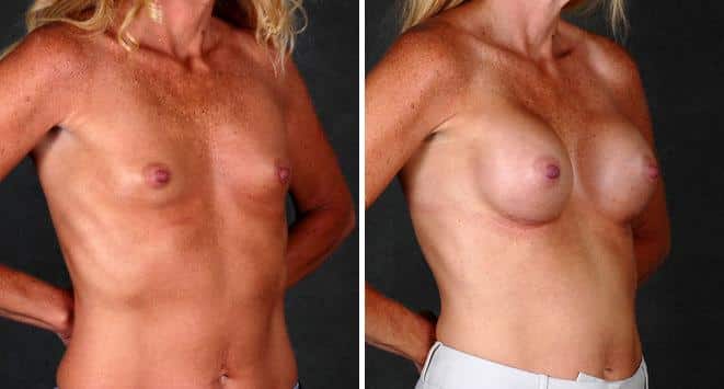 Breast Augmentation Before and After Photos in Omaha, NE, Case 5021