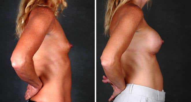 Breast Augmentation Before and After Photos in Omaha, NE, Case 5021