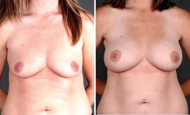 Breast Augmentation Before and After Photos in Omaha, NE, Case 4959