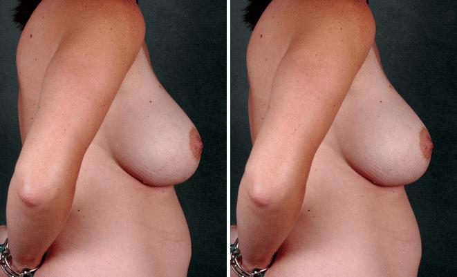 Breast Augmentation Before and After Photos in Omaha, NE, Case 4959