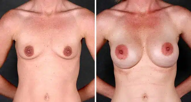 Breast Augmentation Before and After Photos in Omaha, NE, Case 4934