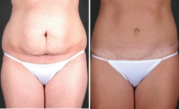 Tummy Tuck Before and After Photos in Omaha, NE, Case 4976