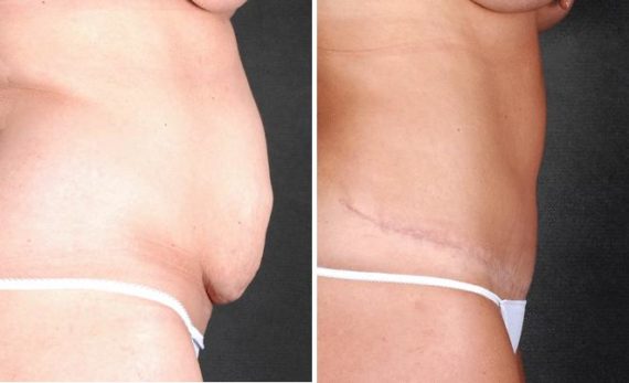 Tummy Tuck Before and After Photos in Omaha, NE, Case 4976