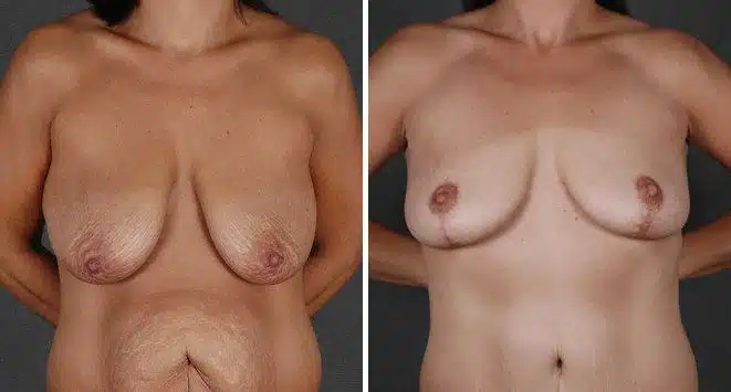 Tummy Tuck Before and After Photos in Omaha, NE, Case 4977