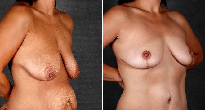 Tummy Tuck Before and After Photos in Omaha, NE, Case 4977