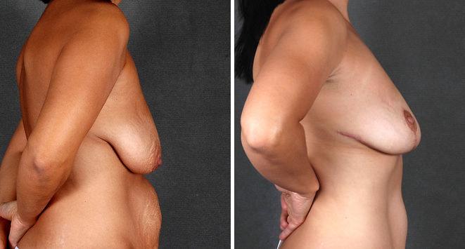 Tummy Tuck Before and After Photos in Omaha, NE, Case 4977