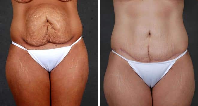 Tummy Tuck Before and After Photos in Omaha, NE, Case 4977