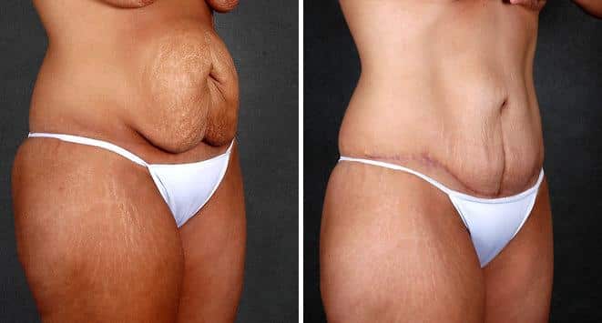 Tummy Tuck Before and After Photos in Omaha, NE, Case 4977