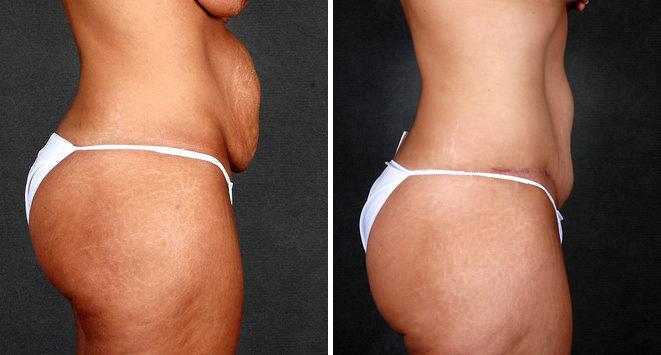 Case 4977, Tummy Tuck Before and After Photos Tummy Tuck Before and After Photos in Omaha, NE, Case 4977