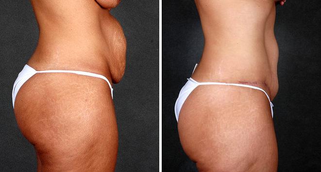 Tummy Tuck Before and After Photos in Omaha, NE, Case 4977