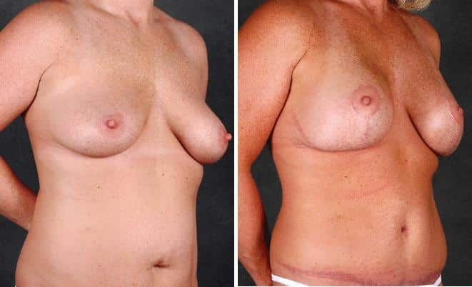 Tummy Tuck Before and After Photos in Omaha, NE, Case 4985