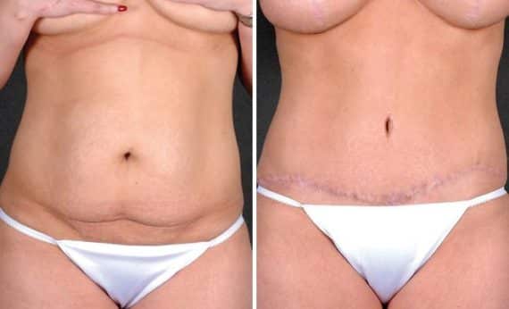 Tummy Tuck Before and After Photos in Omaha, NE, Case 4993