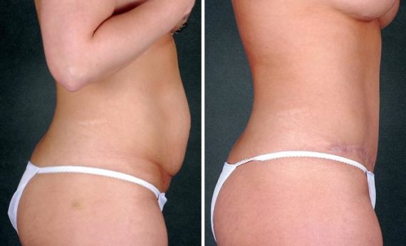 Tummy Tuck Before and After Photos in Omaha, NE, Case 4993