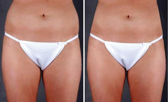 Case 4993, Tummy Tuck Before and After Photos Tummy Tuck Before and After Photos in Omaha, NE, Case 4993