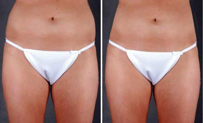 Tummy Tuck Before and After Photos in Omaha, NE, Case 4993