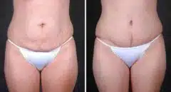 Tummy Tuck Before and After Photos in Omaha, NE, Case 5022