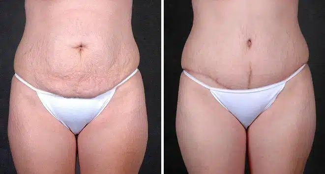 Tummy Tuck Before and After Photos in Omaha, NE, Case 5022