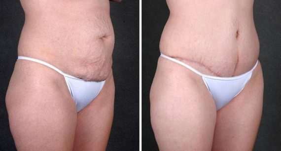 Tummy Tuck Before and After Photos in Omaha, NE, Case 5022