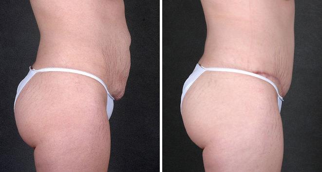 Tummy Tuck Before and After Photos in Omaha, NE, Case 5022